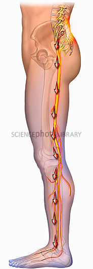 radiculopathy radiculopathy